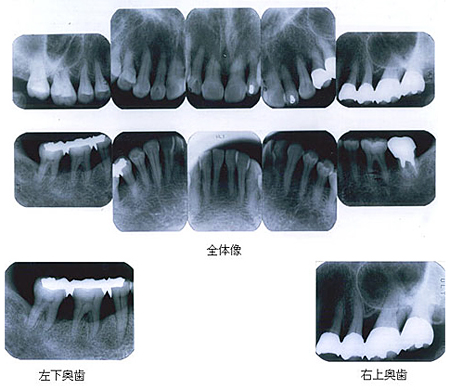 治療終了後レントゲン写真