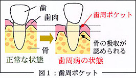 図1：歯周ポケット 写真2：歯周ポケットを計測しているところ