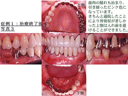 症例1：治療終了後写真3 