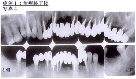 症例1：治療終了後写真4 
