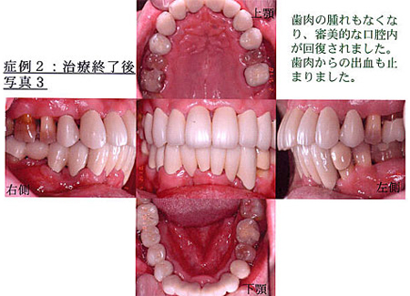 症例2：治療終了後写真3