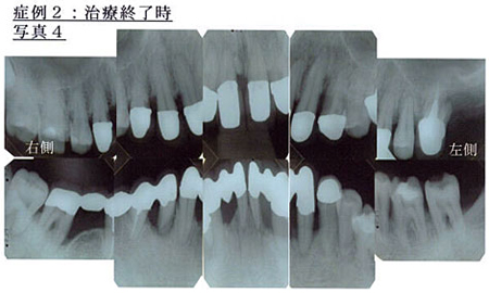 症例2：治療終了時写真4