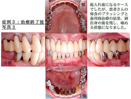 症例3：治療終了後写真3