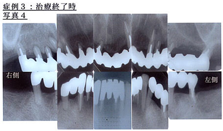 症例3：治療終了時写真4
