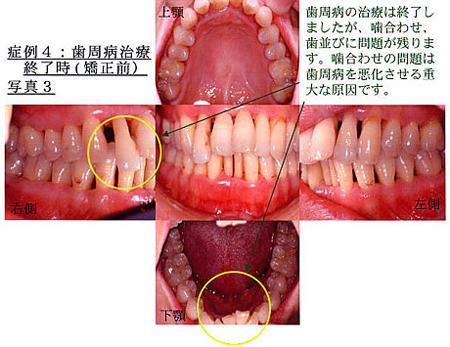 症例4：歯周病治療終了時写真3