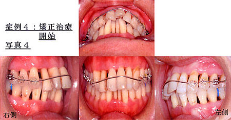 症例4：矯正治療開始写真4