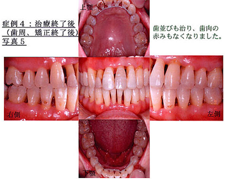 症例4：治療終了後写真5