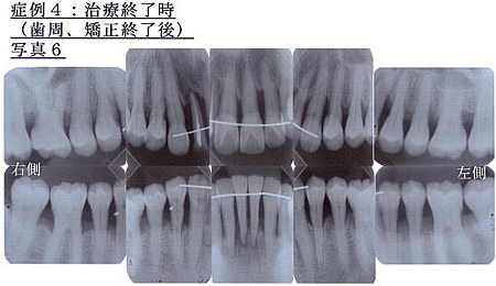 症例4：治療終了時写真6