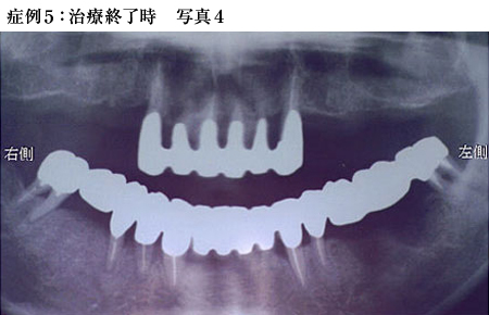 症例5：治療終了時写真4