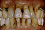 歯周病の方の口腔内写真