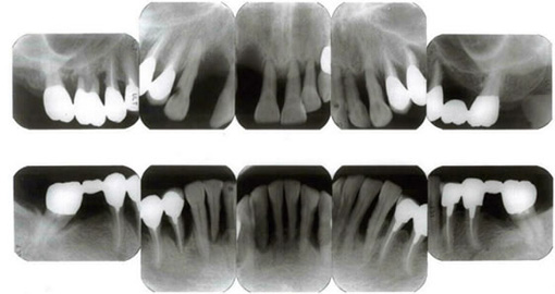 歯周病の方のレントゲン写真