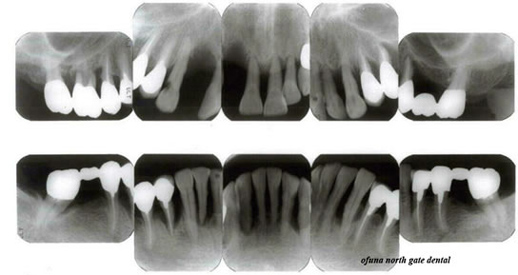 骨吸収が2/3以上ある重度歯周病のレントゲン写真