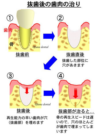 抜歯後の歯肉の治り