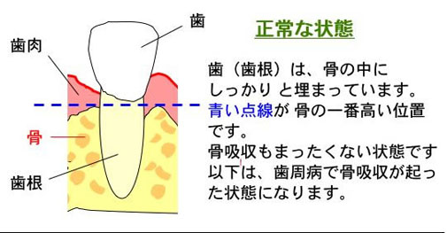 正常な状態　歯根は、骨の中にしっかりと埋まっています。