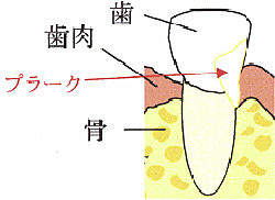 歯周病繁殖の仕方 写真1