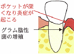 歯周病繁殖の仕方 写真2 