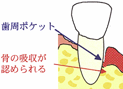 歯周病繁殖の仕方 写真3 