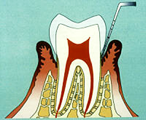 歯周病（軽度）