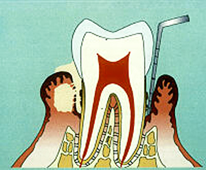 歯周病（中程度）