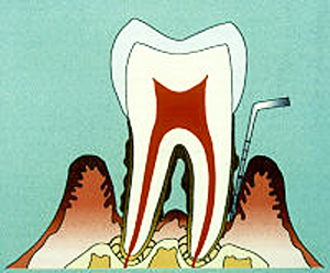 歯周病（重度）