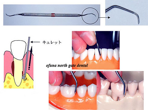 歯周病の基本治療ルートプレーニング