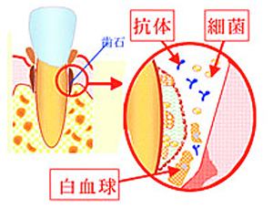 歯周病（中程度）