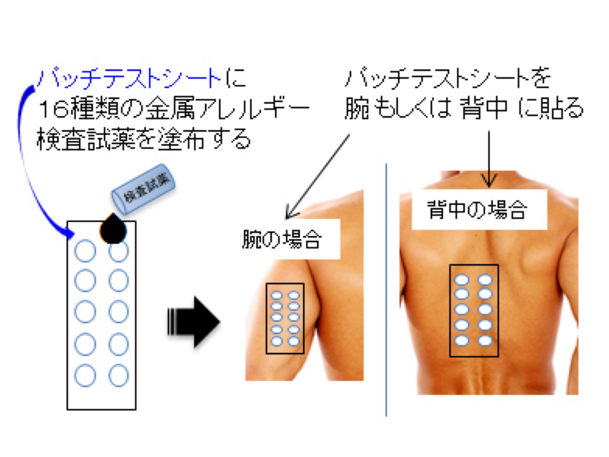 金属 アレルギー パッチ テスト